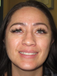 Adelle A Before-Retreatment