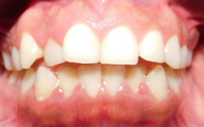 Adelle A Before-Teeth Retreatment