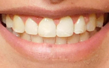 Alicia Talk After-Teeth Transfer