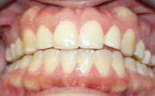 Alicia Talk Before-Teeth Transfer