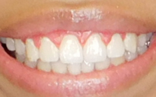 Arius After-Teeth Open Bite