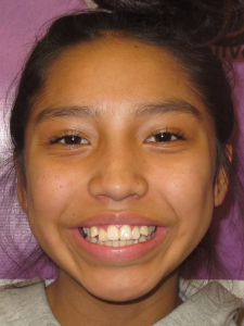 Arius Before-Open Bite