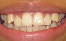 Arius Before-Teeth Open Bite