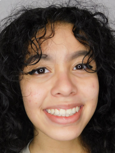 Ashley M After-Class II Extraction (New Section)