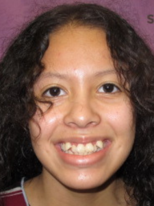 Ashley M Before-Class II Extraction (New Section)