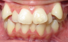 Ashley M Before-Teeth Class II Extraction (New Section)