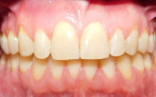 Casey Cline After- Teeth Normal Bite