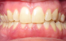 Casey Cline Before- Teeth Normal Bite