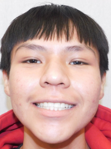 Dishaum J After-OverBite