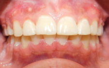 Dishaum J After- Overbite