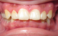 Dishaum J Before- Overbite