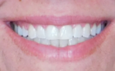 Jeannie S After-Teeth Wider Smile