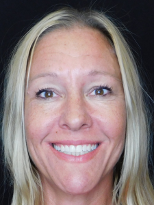 Jeannie S After-Wider Smile