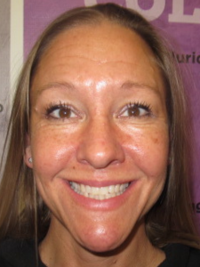 Jeannie S Before-Wider Smile