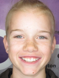 Jude E After- Phase I Early Treatment