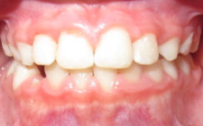 Jude E After-Teeth Phase I Early Treatment