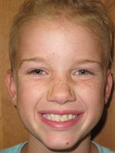 Jude E Before- Phase I Early Treatment