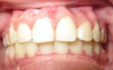 Kamali Before-Crowding