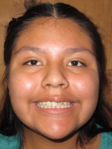 Kamali Before Face-Crowding