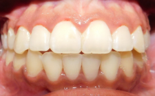 Kiona After- Normal Bite