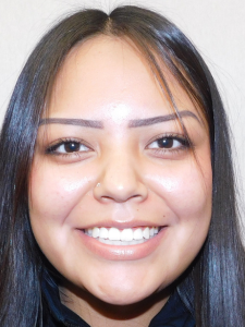 Kiona After-Normal Bite