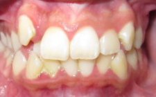 Kiona Before- Normal Bite