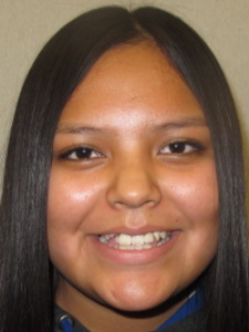 Kiona Before-Normal Bite