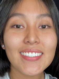 Lakyara After-Normal Bite