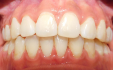 Lakyara After- Teeth Normal Bite