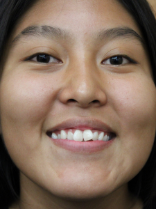 Lakyara Before-Normal Bite