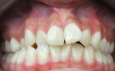 Lakyara Before- Teeth Normal Bite