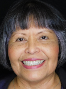 Linda Markle After-Bracelift