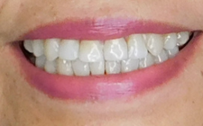 Linda Markle After-Teeth Bracelift