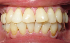 Linda Markle Before-Teeth Bracelift