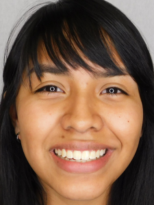 Mackenzie After-Normal Bite