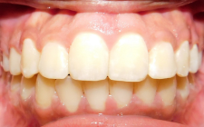 Mackenzie After- Teeth Normal Bite