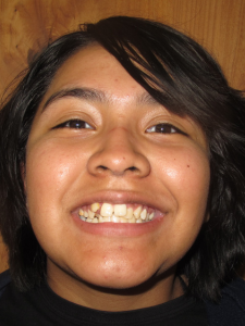 Mackenzie- Before Normal Bite