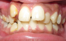 Mackenzie Before- Teeth Normal Bite