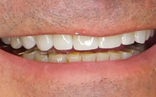 Mike Culver After-Teeth Combo Dental