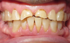 Mike Culver Before-Teeth Combo Dental