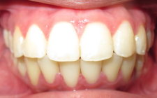 Shaydreanna After- Wider Smile