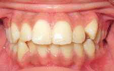 Shaydreanna Before- Wider Smile