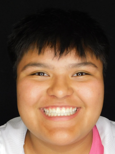 Shyla P After- Teeth Underbite