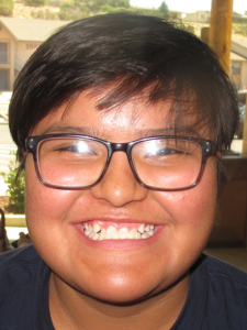 Shyla P Before-Underbite