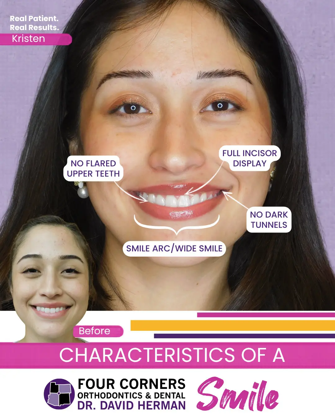 The Role of Pitts21 System of Braces in Enhancing Oral Health and Function