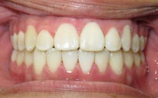 Farmington Orthodontist - Patient Before & After Images