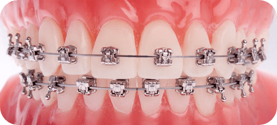 Orthodontics - Four Corners Orthodontics & Dental