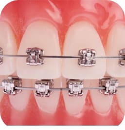 Four Corners Orthodontics & Dental - Pitts 21 treatment