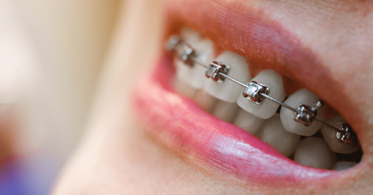 Life with Pitts21 System of Braces Tips for Comfort and Care During Treatment