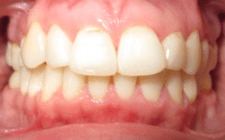 Adelle A After-Teeth Retreatment